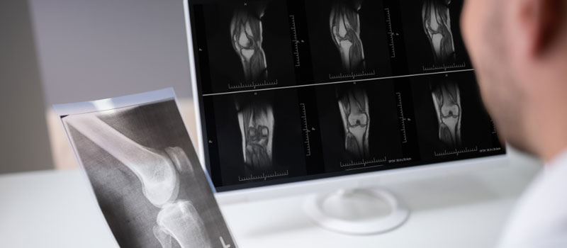 Knee X-Ray at Home in Mumbai