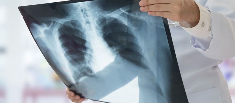 Safe Chest X-Ray at Home in Mumbai